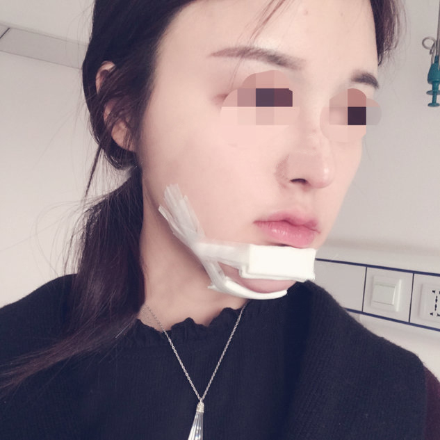 假体垫下巴恢复过程图 北京二炮假体垫下巴