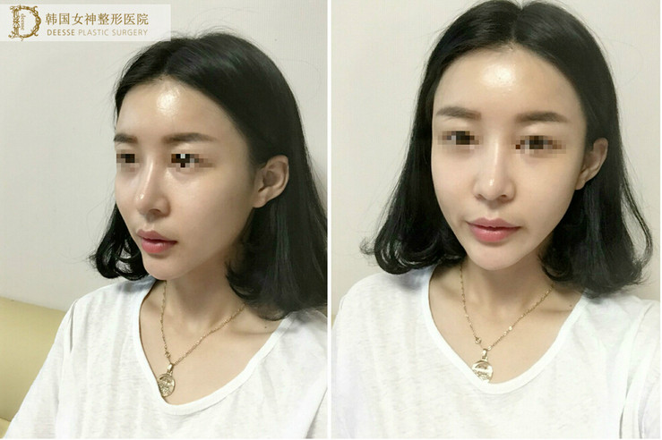 全面部自体脂肪填充前后照片对比和恢复过程记录