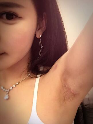 曼托妙桃琴面假体隆胸术前后对比照和恢复过程分享