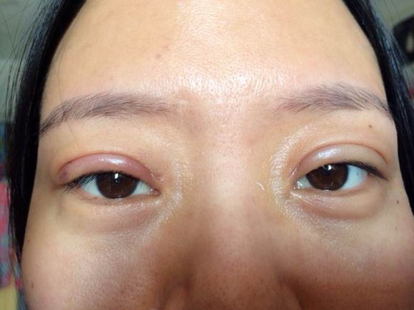 韩式微创小切口双眼皮整形经历分享和前后对比照