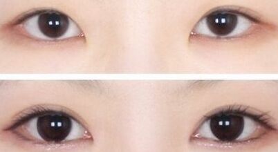 郑州双眼皮失败修复多少钱、费用多少