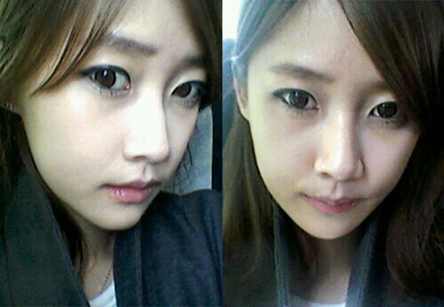 在北京艺星医疗美容医院做下颌角整形手术真实经历