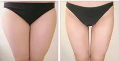 上海大腿吸脂减肥多少钱 大腿吸脂术后注意事项