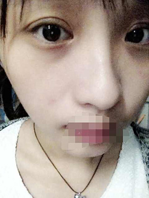 割双眼皮恢复过程图