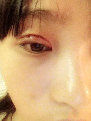 双眼皮恢复过程经历