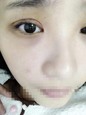 割双眼皮恢复过程图