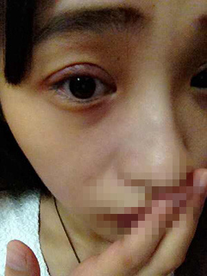 割双眼皮恢复过程图