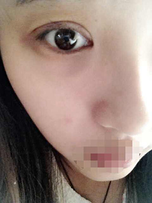 割双眼皮恢复过程图