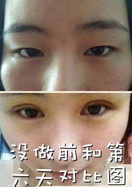 全切双眼皮十天啦~来看看我的果