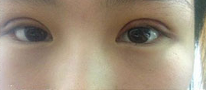 全切双眼皮十天啦~来看看我的果