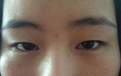 全切双眼皮十天啦~来看看我的果