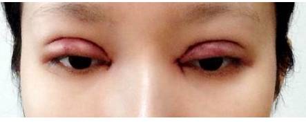 全切双眼皮+去皮去脂+开眼角一个月了~