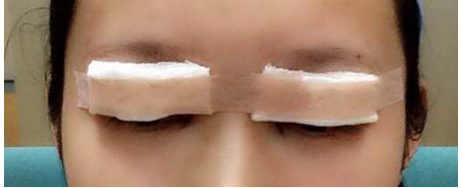 全切双眼皮去皮去脂开眼角恢复过程