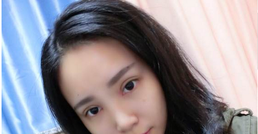 全切双眼皮+去皮去脂+开眼角一个月了~