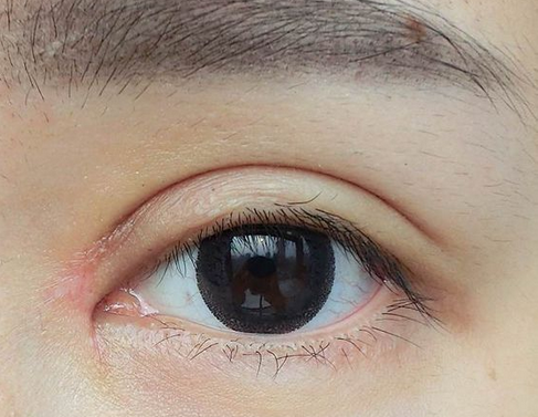 全切双眼皮+去皮去脂+开眼角一个月了~