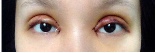 全切双眼皮+去皮去脂+开眼角一个月了~