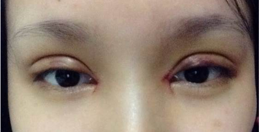 全切双眼皮+去皮去脂+开眼角一个月了~