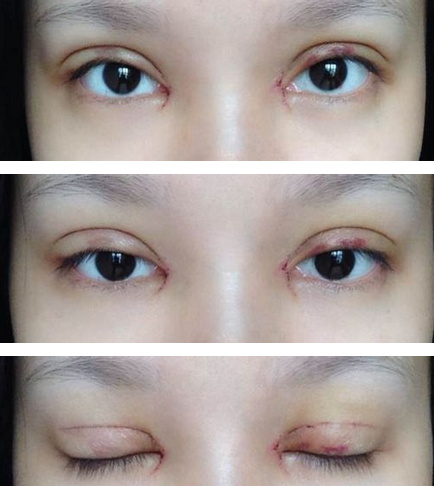 全切双眼皮+去皮去脂+开眼角一个月了~