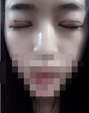 做埋线双眼皮一周啦~果满满的！