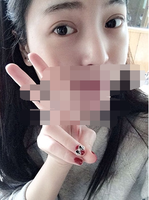 做埋线双眼皮一周啦~果满满的！