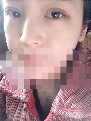 做埋线双眼皮一周啦~果满满的！