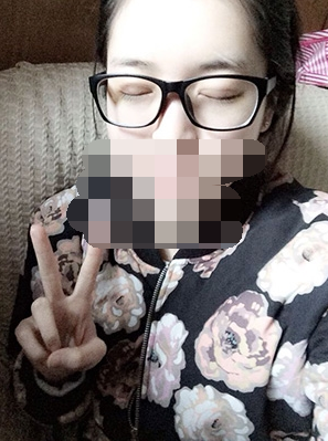 做埋线双眼皮一周啦~果满满的！