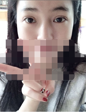 做埋线双眼皮一周啦~果满满的！