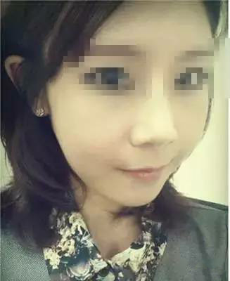 隆鼻+面部填充手术20天康复记录