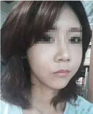 隆鼻+面部填充手术20天康复记录