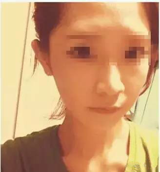 隆鼻+面部填充手术20天康复记录