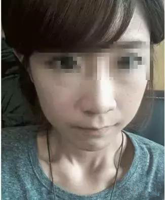 隆鼻+面部填充手术20天康复记录