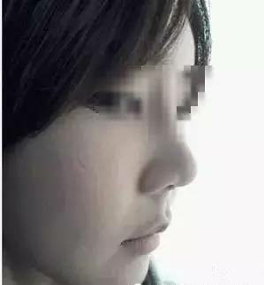 隆鼻+面部填充手术20天康复记录