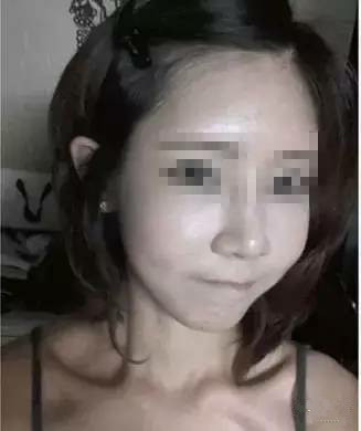 隆鼻+面部填充手术20天康复记录