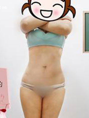 腰部吸脂 水桶腰变成小蛮腰啦