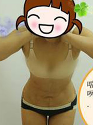 腰部吸脂 水桶腰变成小蛮腰啦