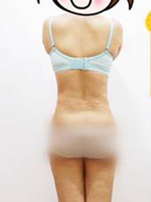 腰部吸脂 水桶腰变成小蛮腰啦