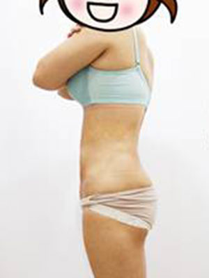 腰部吸脂 水桶腰变成小蛮腰啦