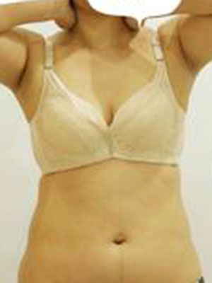 腰部吸脂 水桶腰变成小蛮腰啦