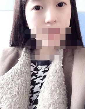 做埋线双眼皮一周啦~果满满的！