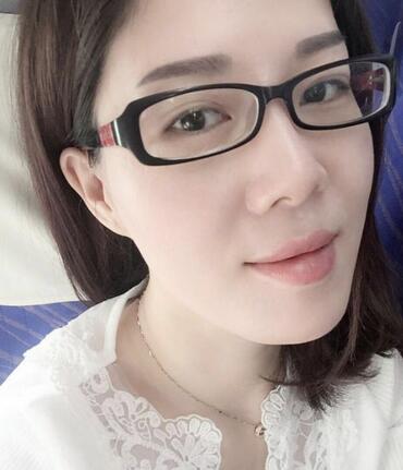 双眼皮恢复记录 果很满意~