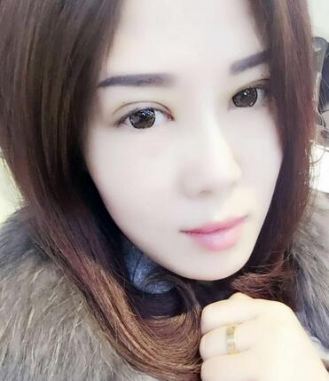 双眼皮恢复记录 果很满意~