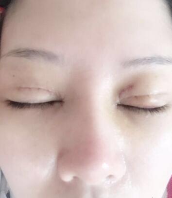 双眼皮恢复记录 果很满意~