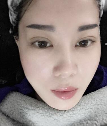 双眼皮恢复记录 果很满意~