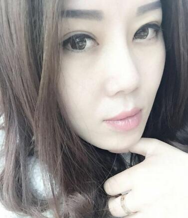 双眼皮恢复记录 果很满意~