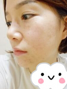 光子嫩肤 我的皮肤也可以白皙Q弹啦~