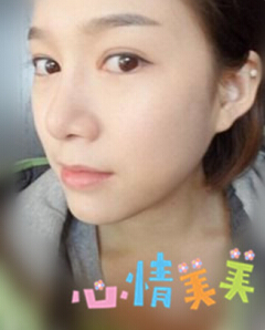 光子嫩肤 我的皮肤也可以白皙Q弹啦~