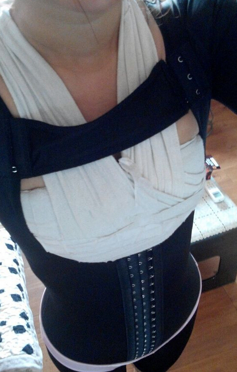 自体脂肪隆胸半个多月了 感觉很好！