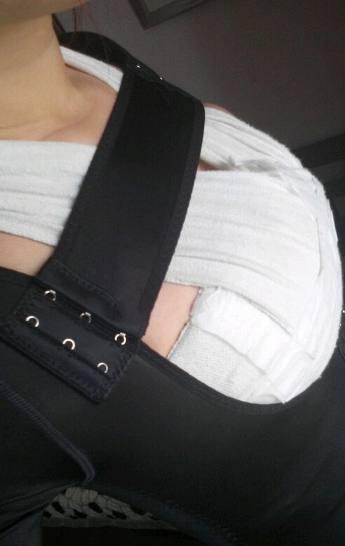 自体脂肪隆胸半个多月了 感觉很好！