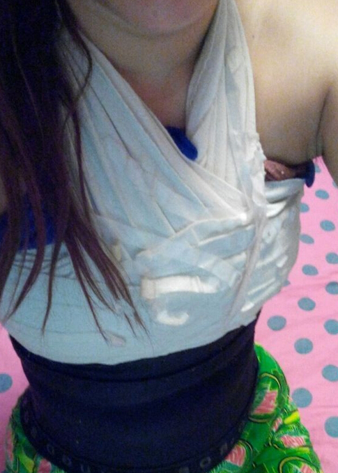 自体脂肪隆胸半个多月了 感觉很好！