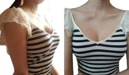 做了自体脂肪隆胸 我也拥有了很辣的身材